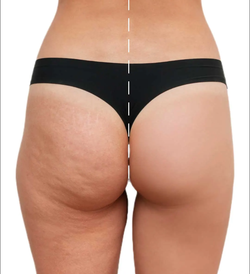 Liquid Lymphatic Drainage - Reduces swelling and helps you regain your figure