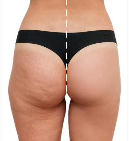 Liquid Lymphatic Drainage - Reduces swelling and helps you regain your figure