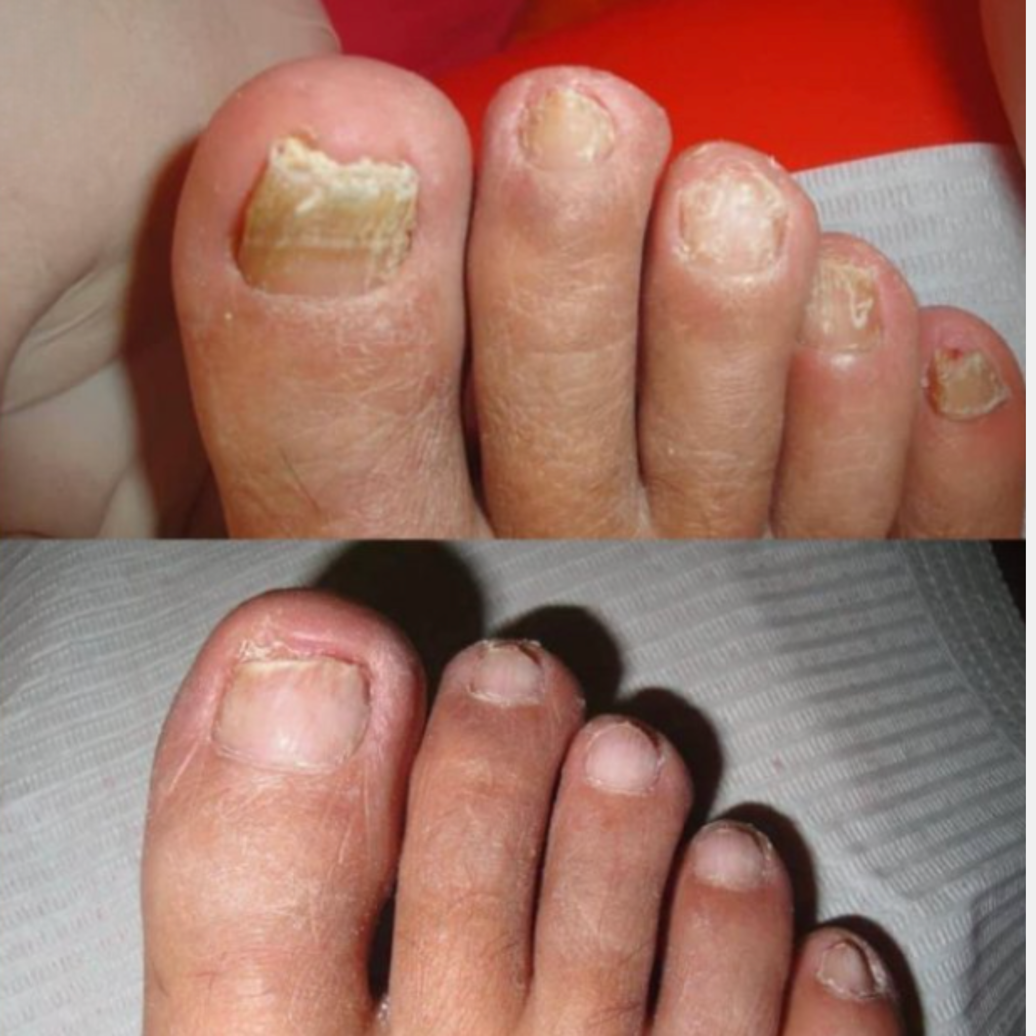 Parches Antihongos para Uñas NaturLab® - Elimina la apariencia del hongo desde la raíz