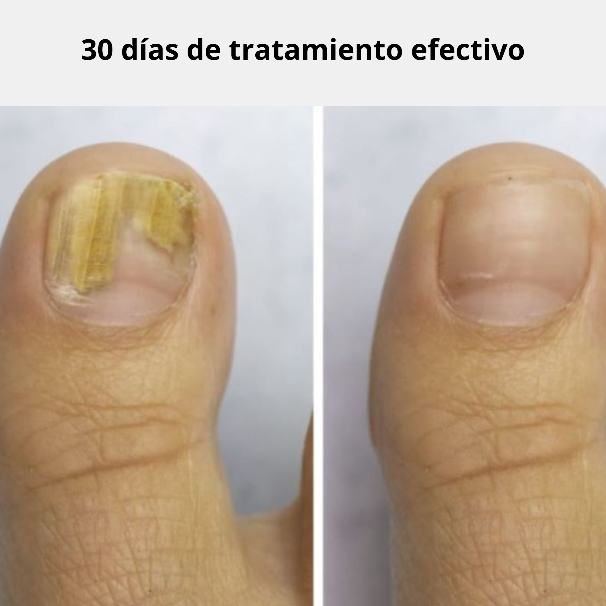 Parches Antihongos para Uñas NaturLab® - Elimina la apariencia del hongo desde la raíz