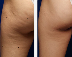 Liquid Lymphatic Drainage - Reduces swelling and helps you regain your figure